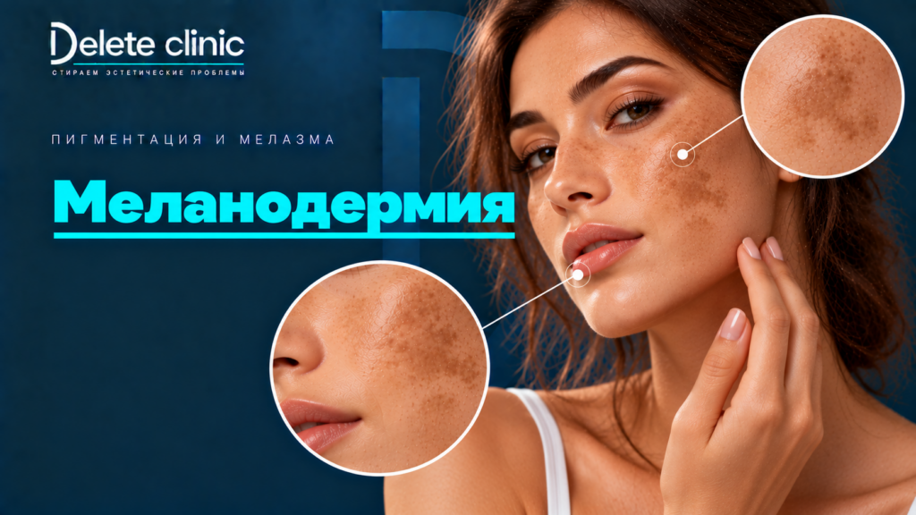 Меланодермия
