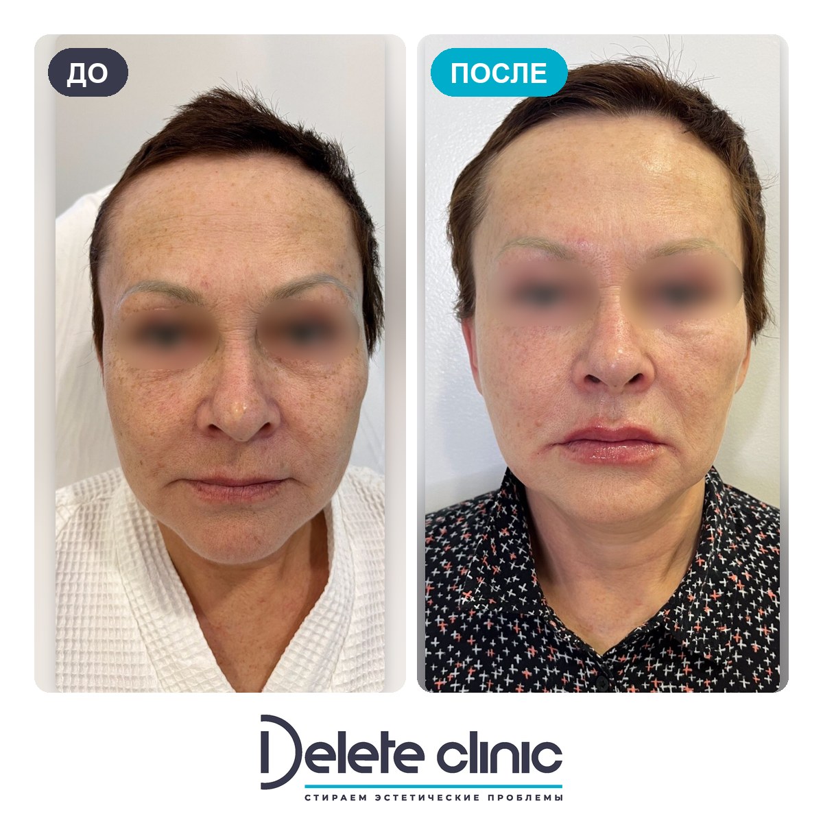 До и после: Омоложение PicoSure