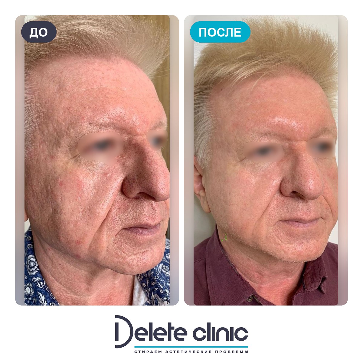 До и после: Омоложение PicoSure