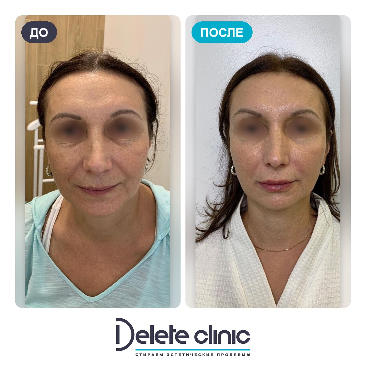 До и после: Омоложение PicoSure