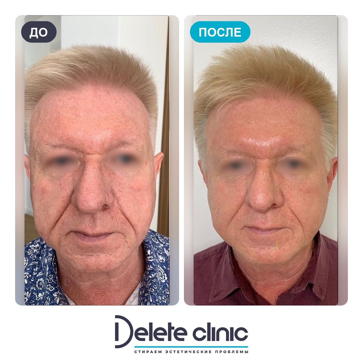 До и после: Омоложение PicoSure